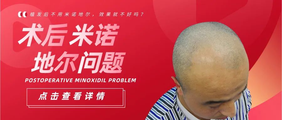 植发后不用米诺地尔，效果就不好吗？