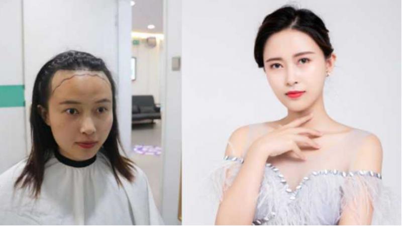 发际线高怎么改善？做对这一步轻松获得美人尖和胎毛