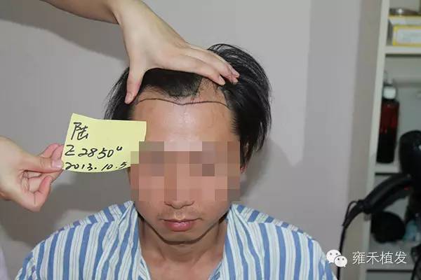 陆先生在上海雍禾植发采用FUE种植2889毛囊单位