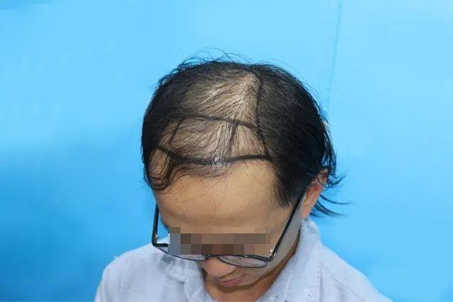 大面积的脱发人群，他们后来都怎么样了？
