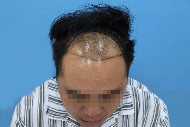 只因这个小动作，却挽救了他的高额发际线