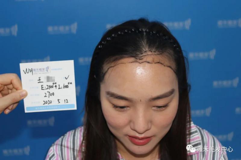一般女性植发2000单位以下，她却植发3000单位