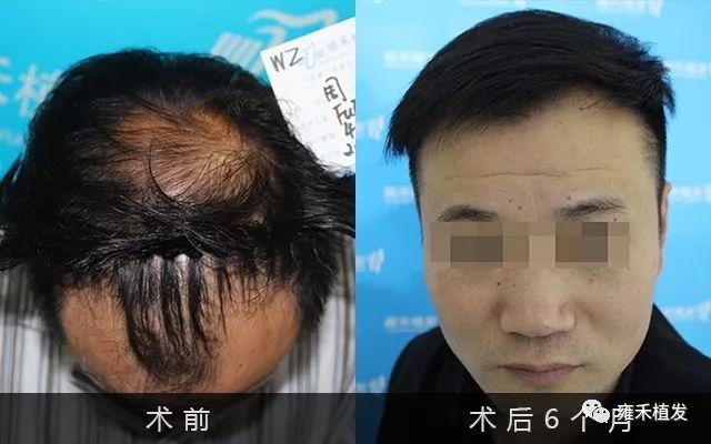 脱发面太大植发没办法？他豁出去植发4300单位