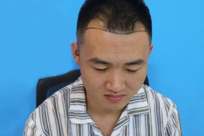 发际线后移可以这样做，上班出差两不误