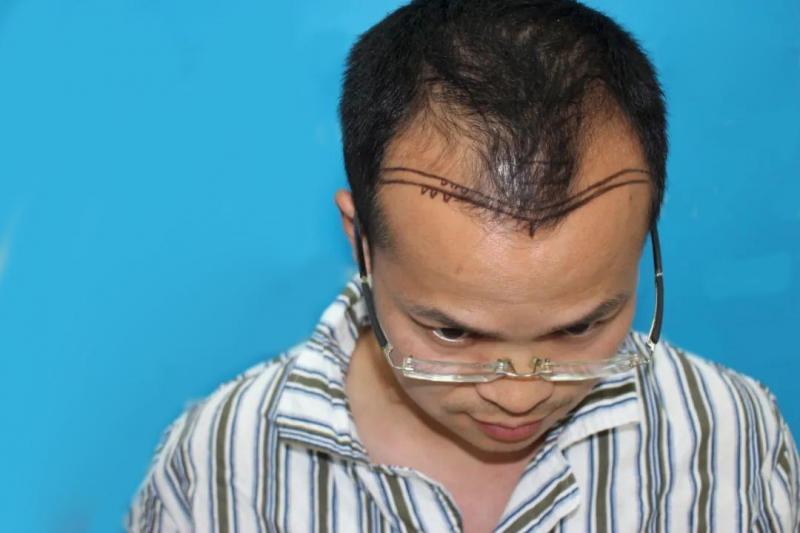 脱发治疗千千万，这种最有效也最直接
