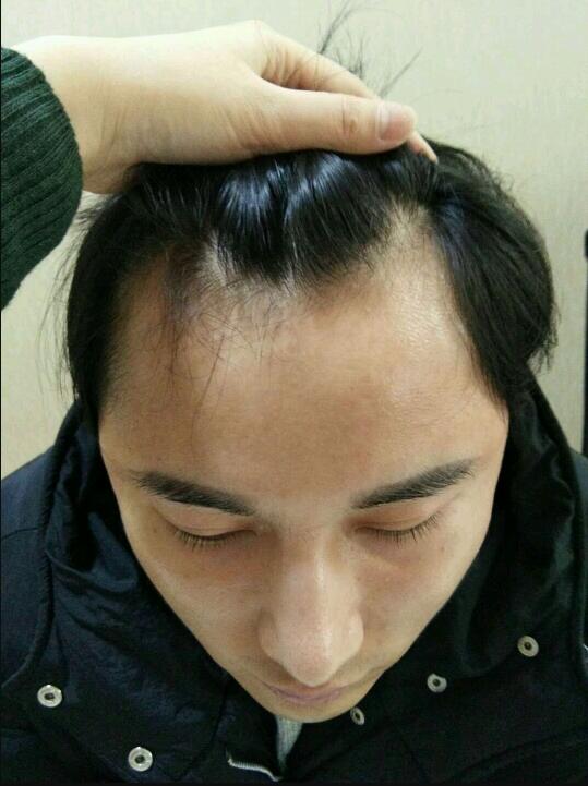 武汉美都做的植发际线术前术后案例对比