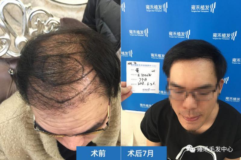 南宁雍禾用FUE为黄先生种植3210单位看到好效果