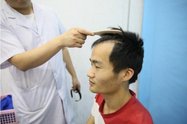 深圳鹏程发际线移植手术术后案例分享