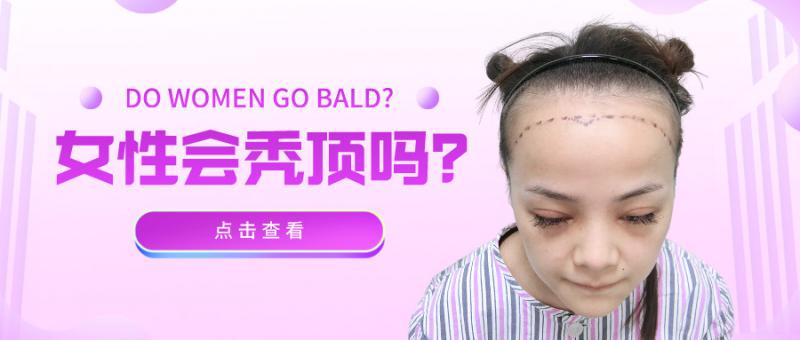 植发案例美女产后脱发植发后年龄逆生长