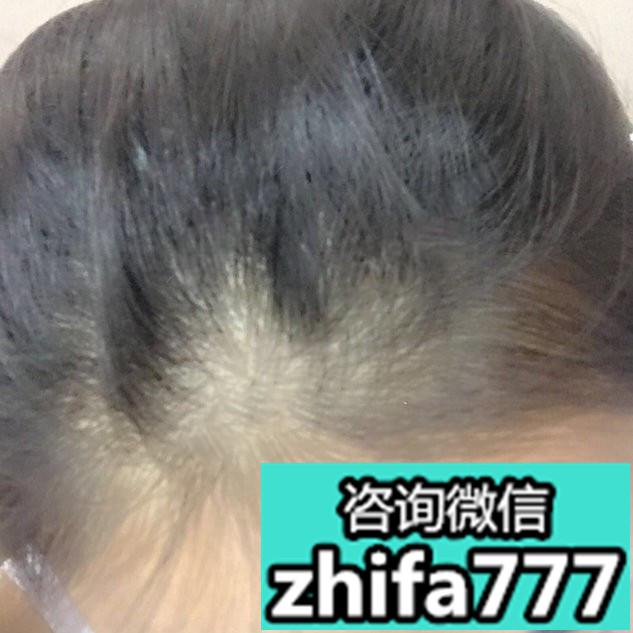 发际线植发两个月术后效果