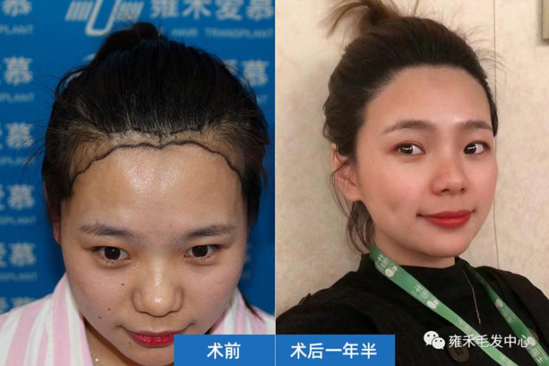 她发际后退不能梳丸子头，植发2070单位1年美上头！