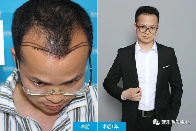 发际线后退植发3250单位年轻五六岁