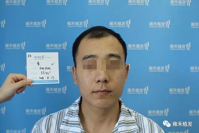 鼓起勇气植发3389单位，赢得好形象，赢得女朋友