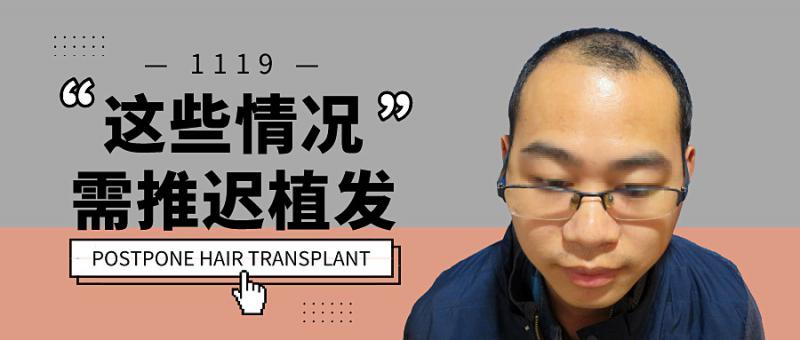 碧莲盛四级脱发植发案例效果图