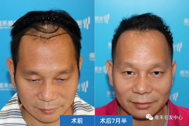 深圳雍禾采用FUE为梁先生植发1600单位对比