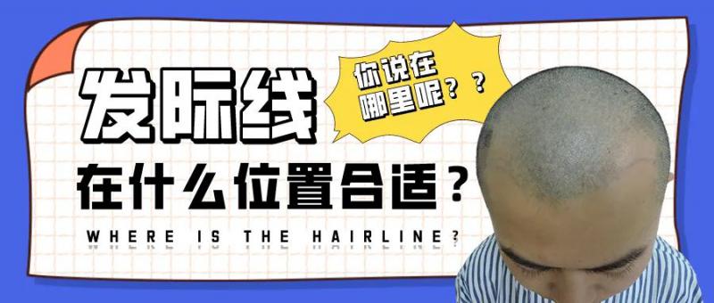 为什么有发友植发时，要把发际线设计地偏高？