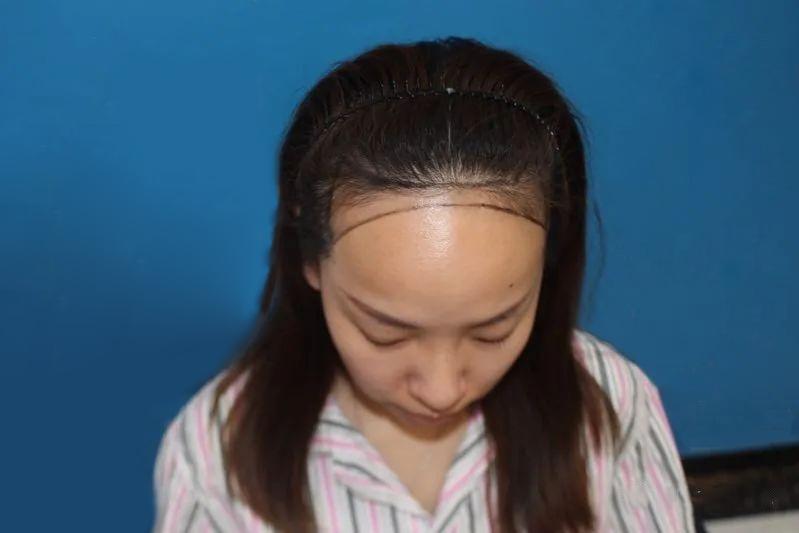 一次植发，终身受用！亲身经历分享心得