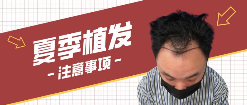 夏季植发好不好？注意事项请查收！