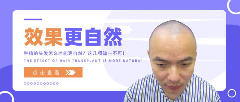 种植的头发怎么才能更自然？这几项缺一不可！