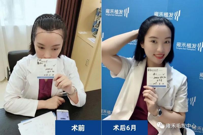 我是女生植发际线1850单位用的技术与男士不一样
