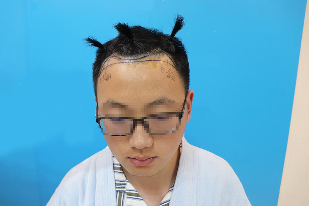 一个无意的动作，却挽救了他的头发