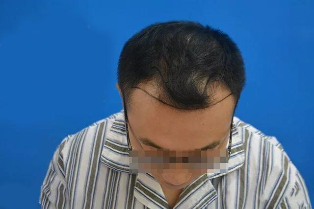 M字额脱发有救吗？植发后的效果让周围人都羡慕