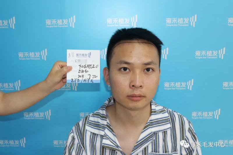 宁波雍禾植发就给小吴种植发际线不理光头植发1100单位