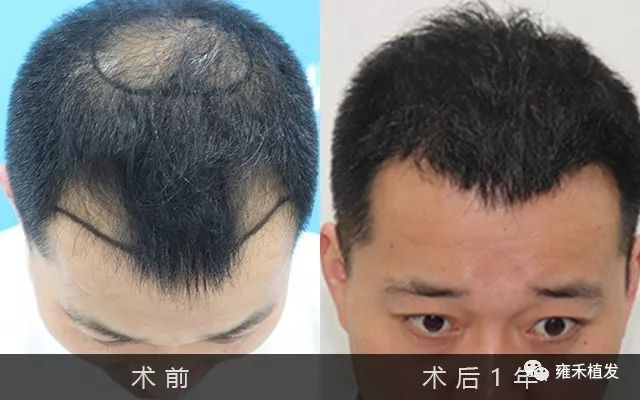 杭州雍禾为徐先生植发4150单位植发效果对比图