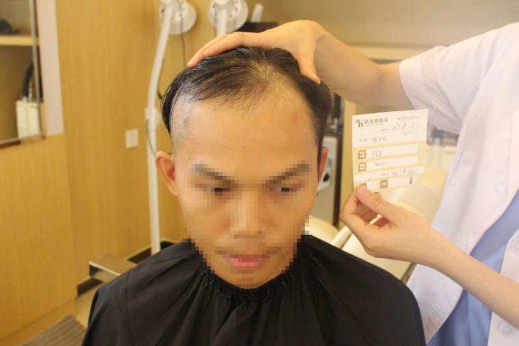 南宁科发源种植头发治疗效果怎么样？术后案例分享