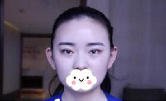 长沙美莱医疗植发机构怎么样？植发案例！！