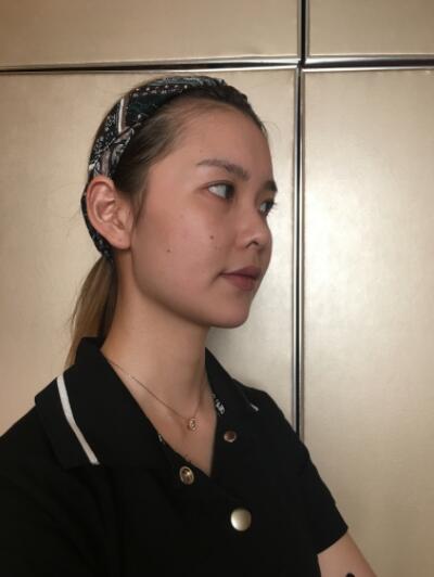 发际线不漂亮要怎么办？可以通过植发改善吗？发际线种植手术后案例分享