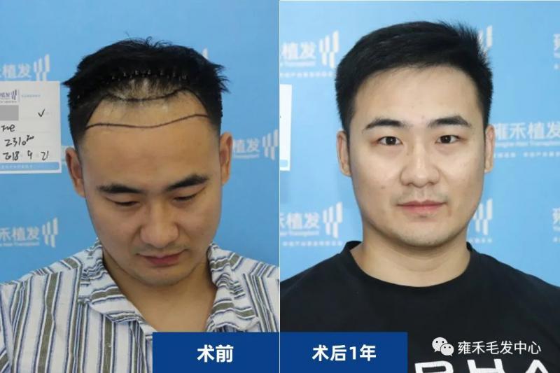 郑州雍禾植发采用FUE为李先生植发2471单位案例图