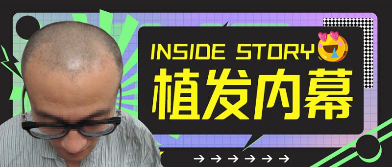碧莲盛植发案例解答什么时候植发价低？