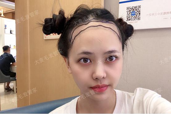 小姐姐发际线过高，选择大麦微针植发艺术种植后的效果！