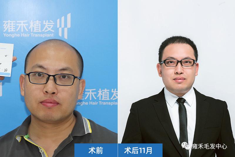 植发真的让一个人返老还童！