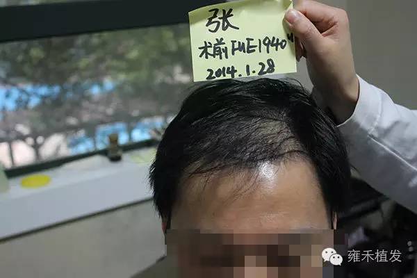 武汉植发老案例他仅用4月雍禾植发就有好植发效果！