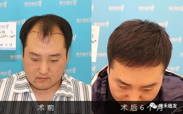 沈阳雍禾植发为姜先生种植3590单位植发前后对比图