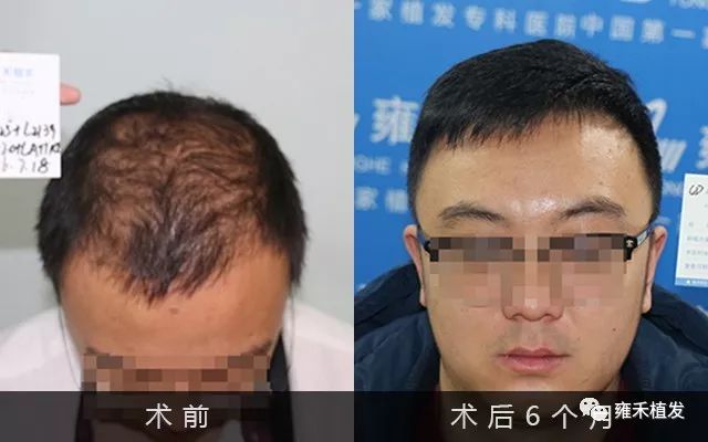 成都植发雍禾为林先生头发种植3050单位效果
