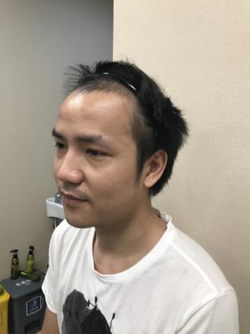 额头太高了，植发可以治疗吗？发际线植发手术案例分享