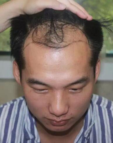 植发医院哪家效果好？术后案例分享