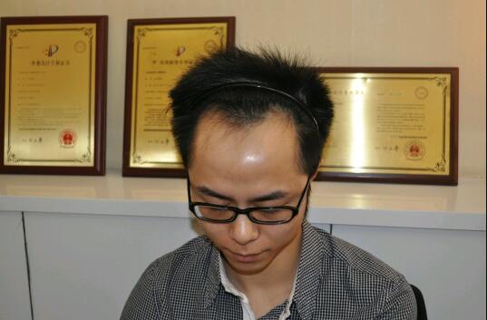 男性脱发平时该如何预防呢？男性植发手术案例分享