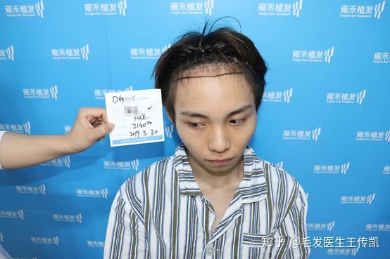 在东莞雍禾植发一年后，什么发型都可以驾驭了