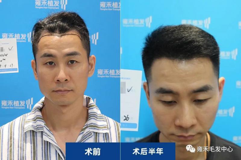 深圳植发雍禾为詹先生种植头发3550单位效果图