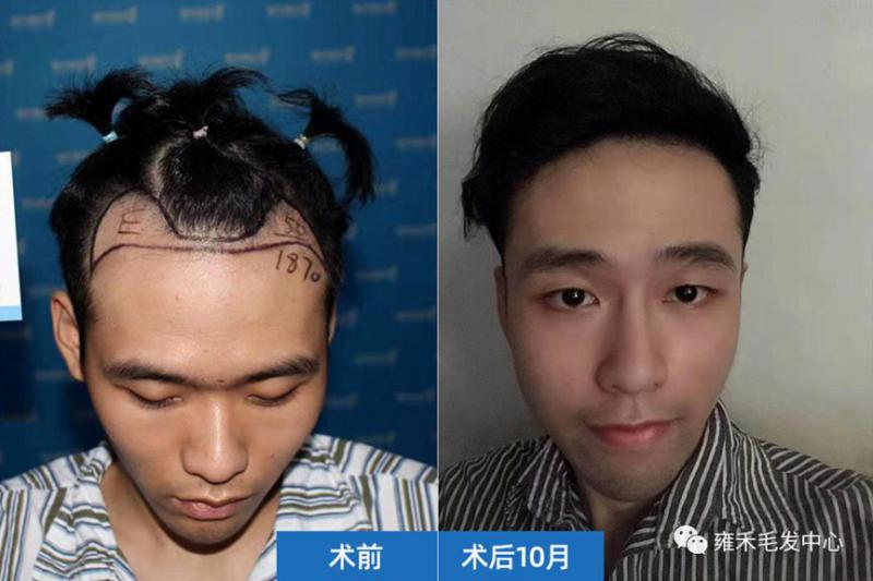 小吴的植发效果两个额角饱满再往后植发效果更好