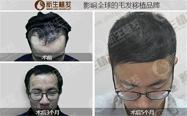 植发到底好不好？来看看上海新生植发案例
