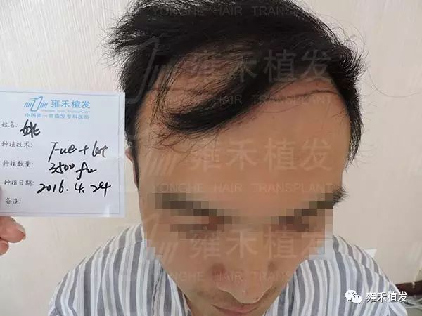 太原雍禾无痕植发3660单位10月超级帅气！