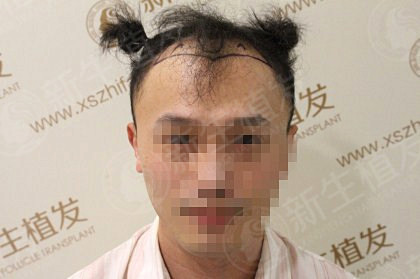 珠海有没有的植发案例