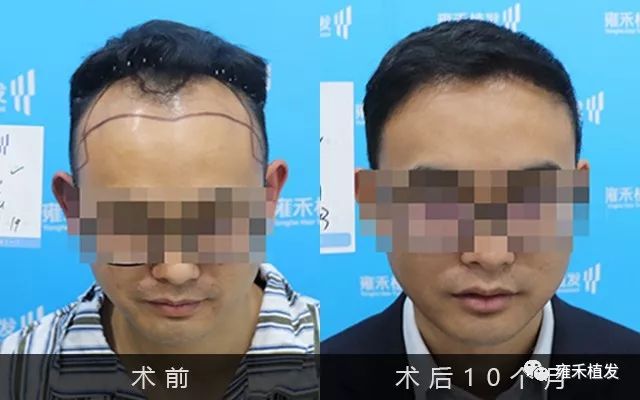 种植发际线，但他不用FUE而是用价格更高的LATTICE技术！