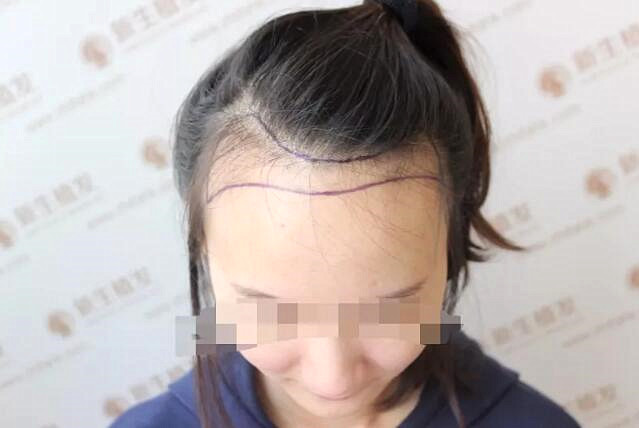 新生小仙女植发案例