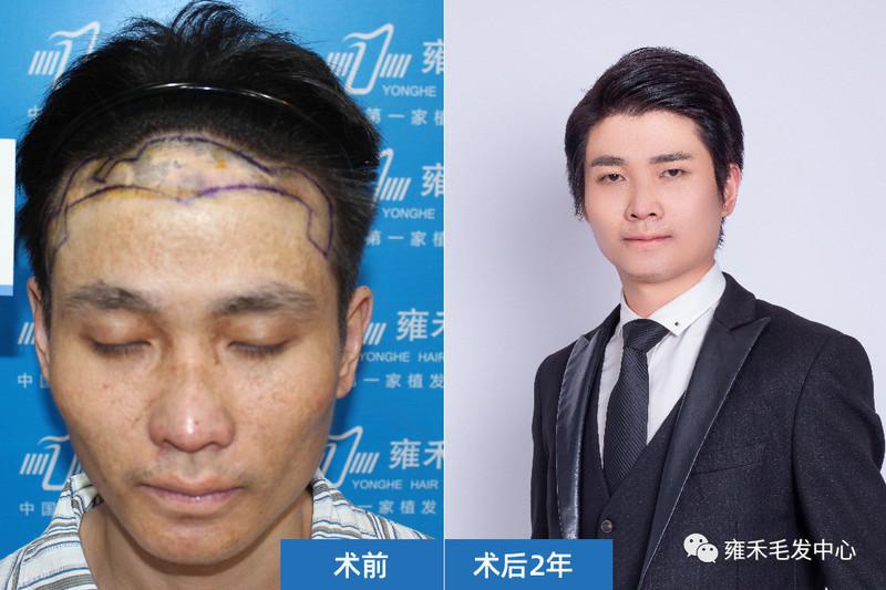 厦门雍禾采用FUE为小孙疤痕植发2392单位